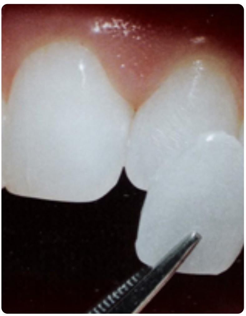 Porcelain Veneers