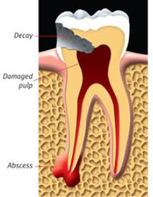 Root Canal Treatment